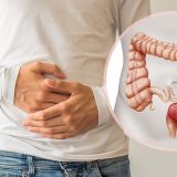 colorectal cancer