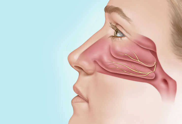 What Is Posterior Nasal Nerve (PNN) Ablation and How Can It Fix a Runny Nose?